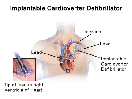 desfibrilador cardioversor implantable (ICD)