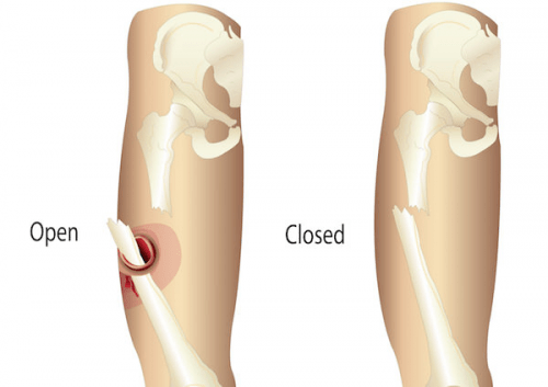 Diferencia entre una fractura abierta y una cerrada